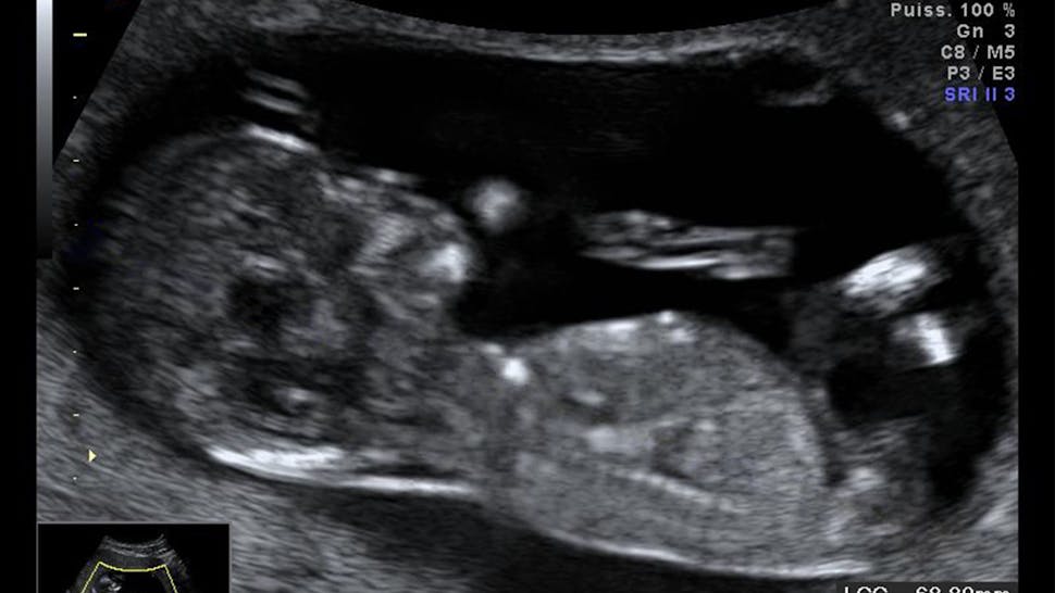 Ultrasound Ultrasound Biometry Of The Fetus, At 13 Weeks.