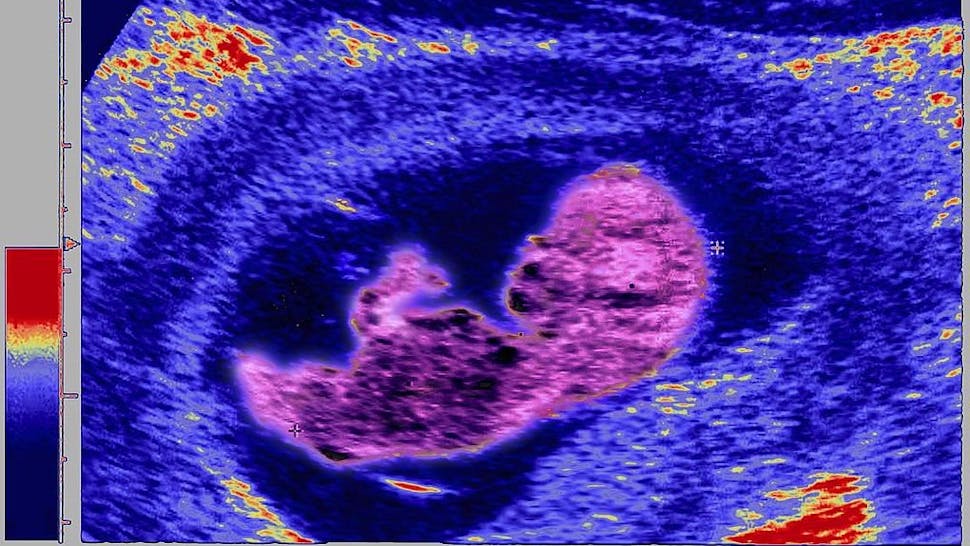 fetus_3rd_month_gi Ultrasound Biometry Of The Fetus, Saggital Section, Fetus In Utero In The Third Month, Measured By Ultrasound Scan.