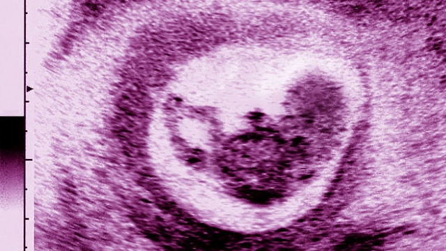 Obstetric Ultrasound Scan Saggital View. Fetus In Utero In The Third Month, The Legs, The Body, A Hand And The Head Are Visible.