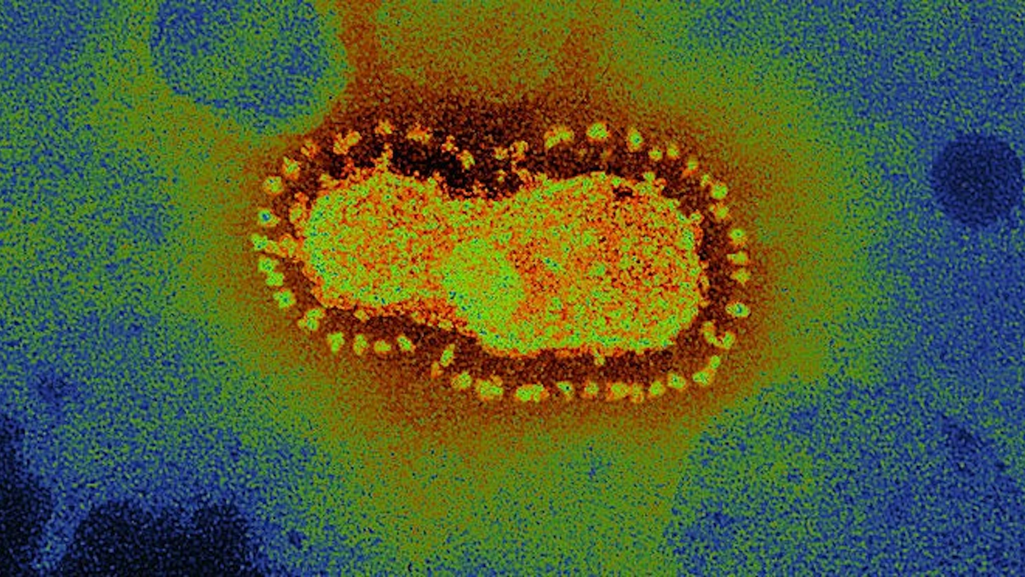 he Crown Shape Of This Virus Gives Its Name, Coronovirus. The Crown Encircles The Viral Capside A Protein Structure Protecting The Viral Nucleic Acid. This Virus Was Isolated From The Fecal Matter Of A Patient With Diarrhea. Colored Transmission Electron Microscopy X 95,000 (Photo By B