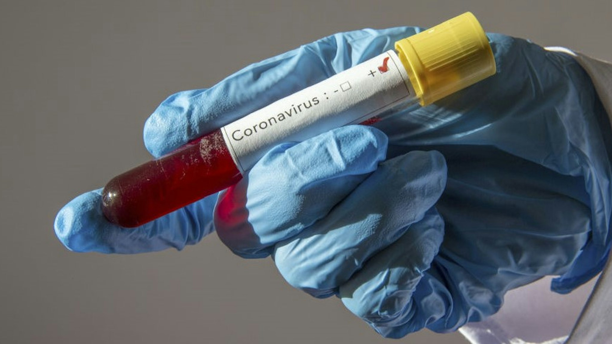 ANKARA, TURKEY - FEBRUARY 14: In this photo illustration a coronavirus (2019-nCoV) positive blood sample is displayed on February 14, 2020 in Ankara, Turkey.