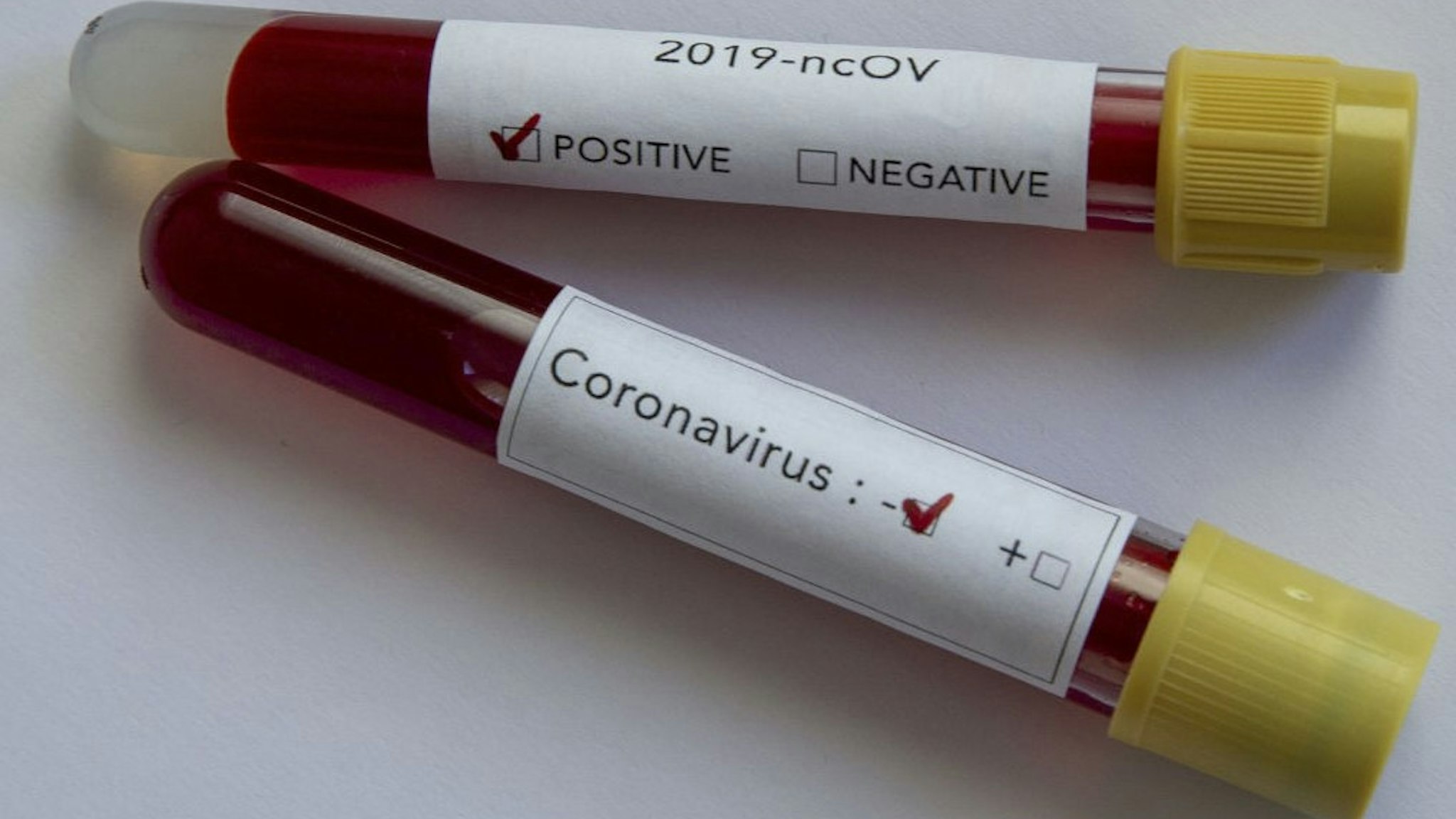 ANKARA, TURKEY - FEBRUARY 14: In this photo illustration coronavirus (2019-nCoV) positive and negative blood samples are displayed on February 14, 2020 in Ankara, Turkey.