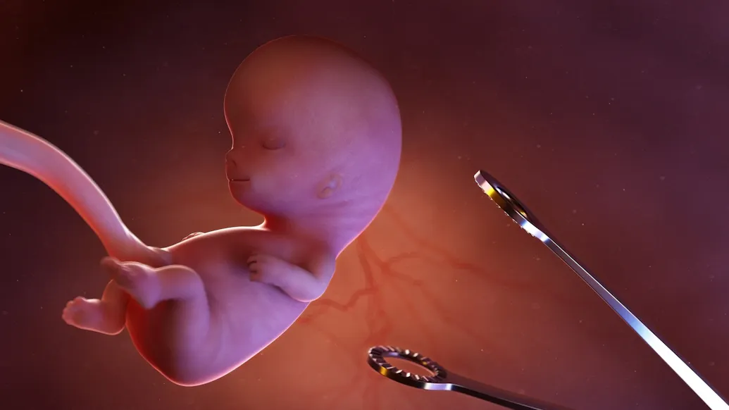 Tennessee Ban On Abortions Due To Down Syndrome, Race, Sex Partially Upheld By Appeals Court