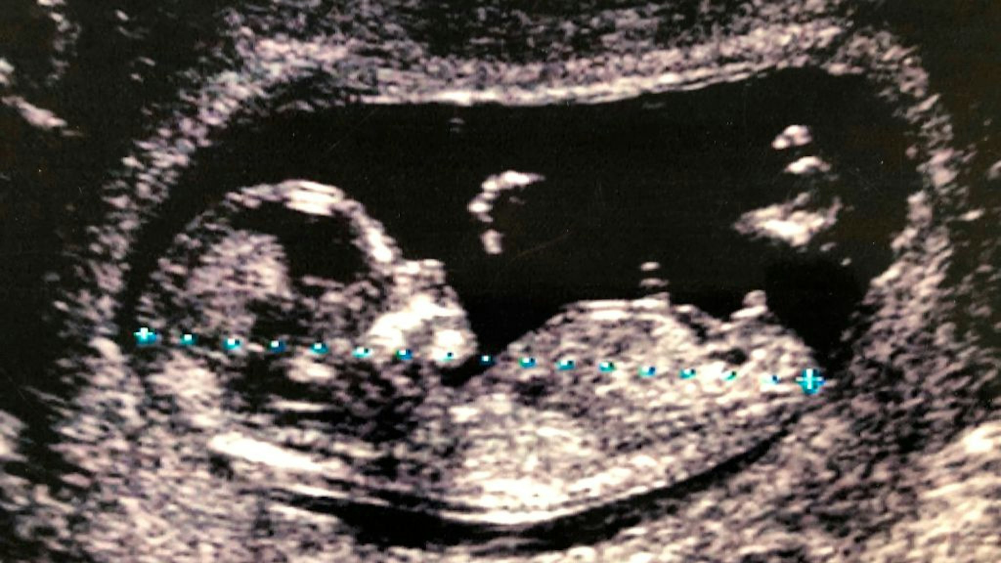 Fetal ultrasound of a 4-month-old fetus.