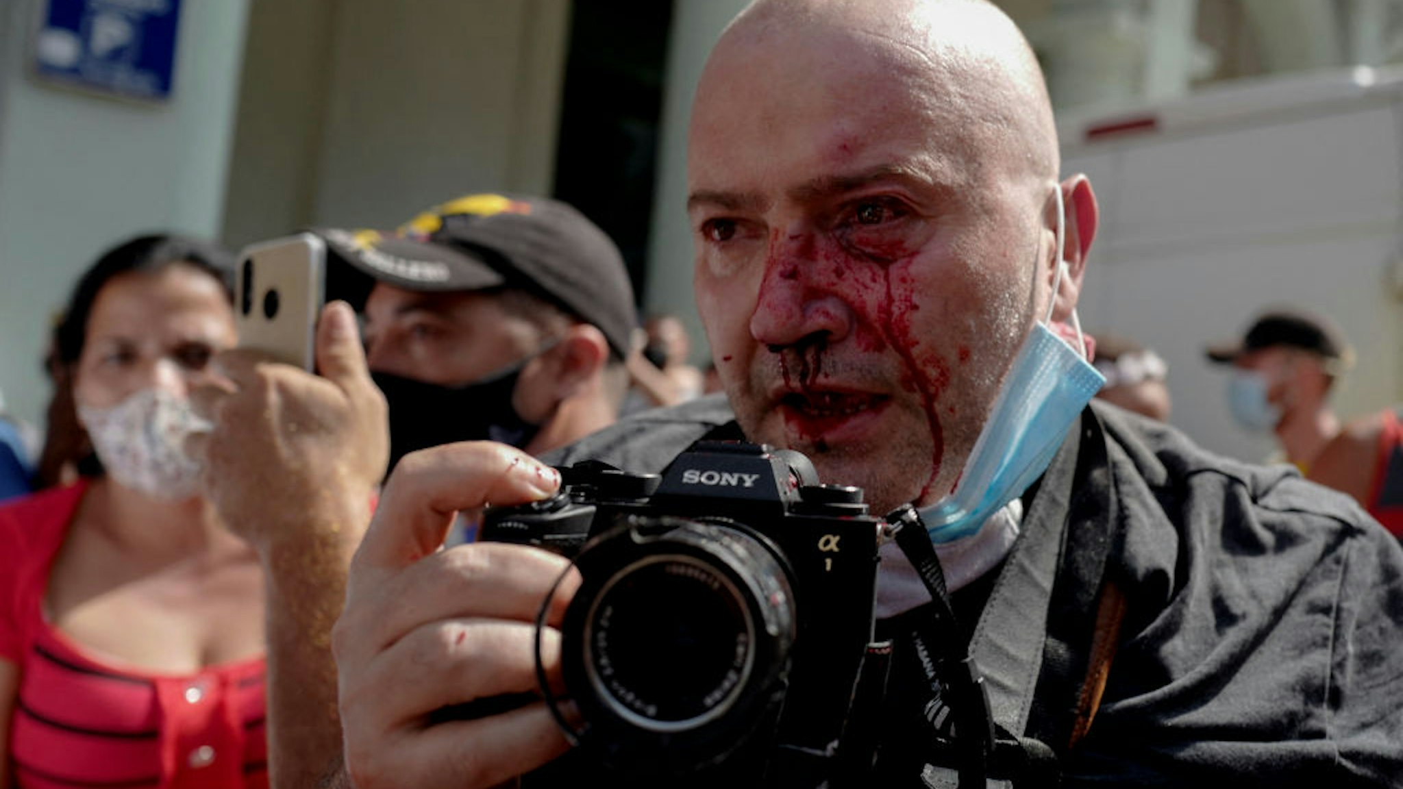 AP photographer, Spanish Ramon Espinosa, is seen with injuries in his face while covering a demonstration against Cuban President Miguel Diaz-Canel in Havana, on July 11, 2021