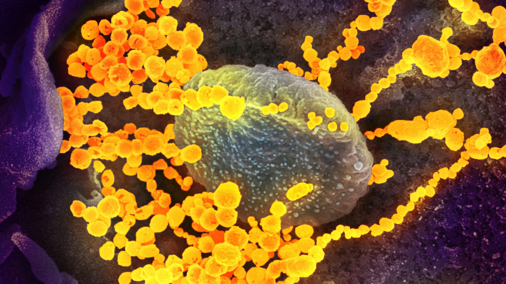 This scanning electron microscope image shows SARS-CoV-2 (round gold objects) emerging from the surface of cells cultured in the lab. SARS-CoV-2, also known as 2019-nCoV, is the virus that causes COVID-19. The virus shown was isolated from a patient in the U.S. Image captured and colorized at NIAID's Rocky Mountain Laboratories (RML) in Hamilton, Montana.