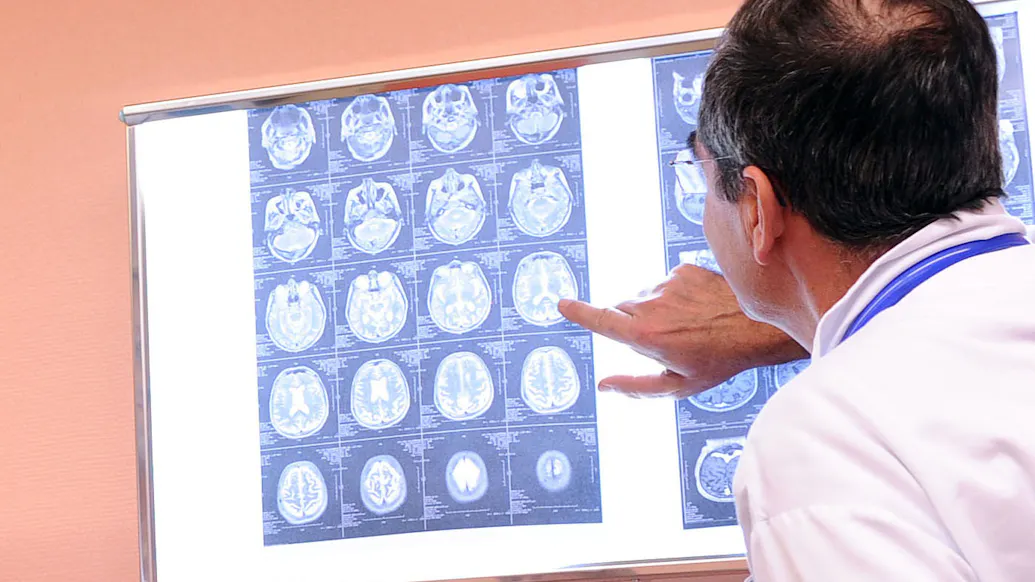 Bombshell: Possible Fraudulent Images Used In Key Alzheimer’s Study Has Misled Research For Years, Report Says