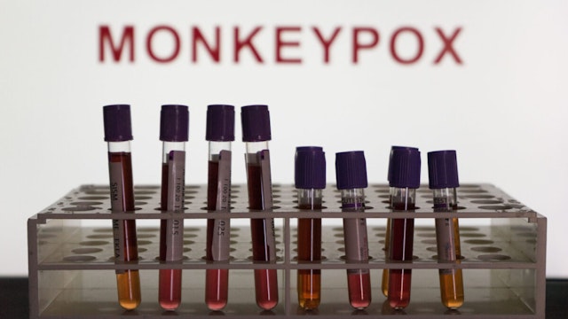 In this photo illustration blood test vials are seen in front of a screen that says &quot;Monkeypox&quot;.