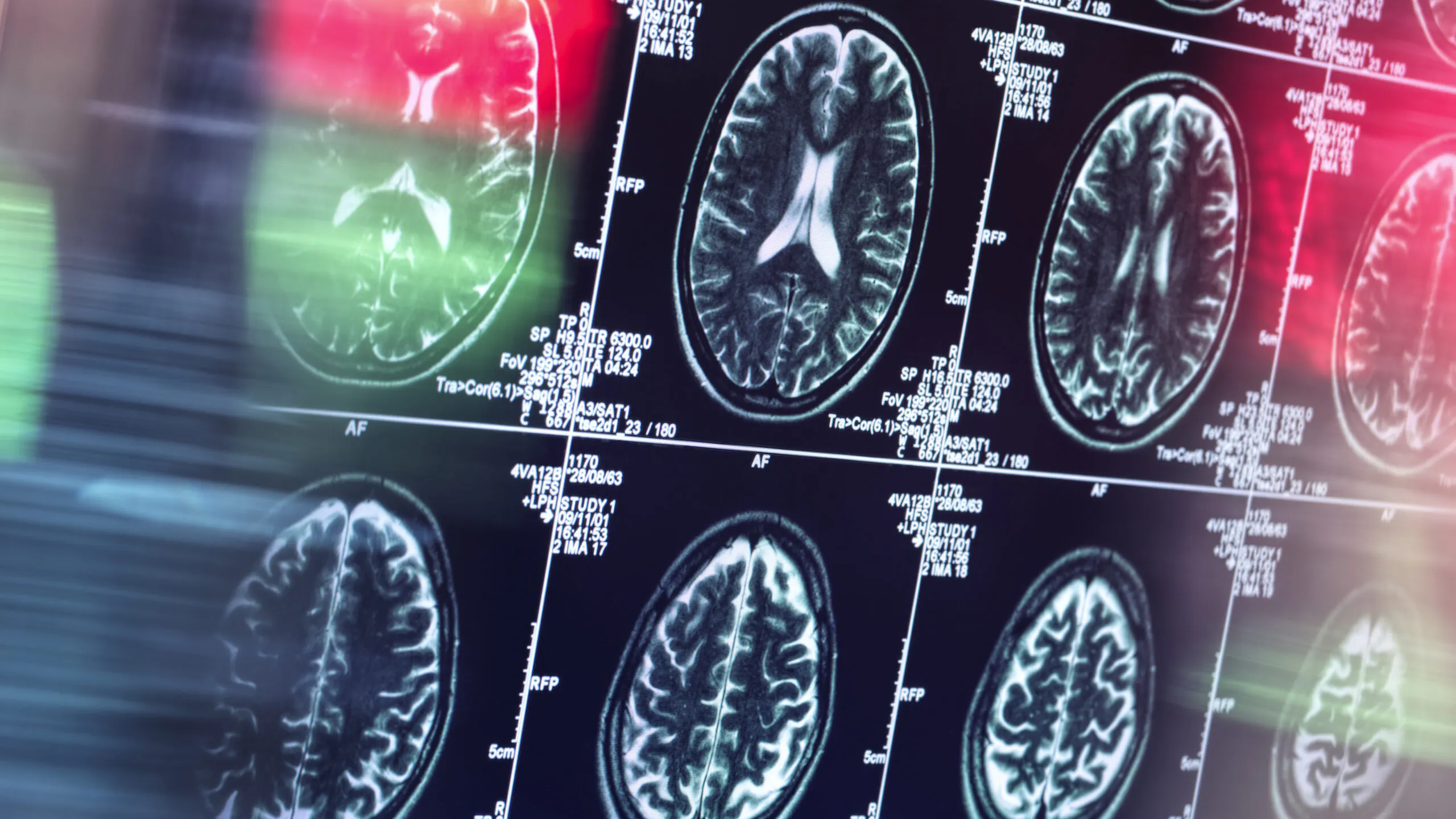 Mind-Controlled Wheelchairs: Study Shows Promising Possibilities For Paralyzed People