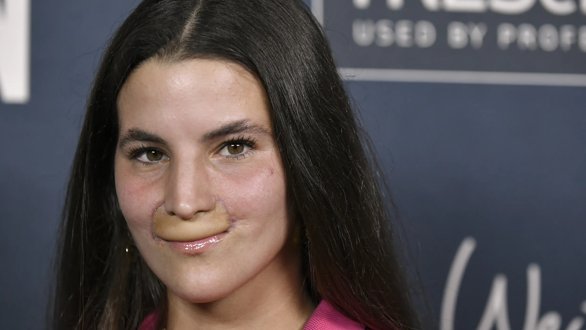 Pro Skateboarder And Model Shows Off New Face After Getting Mauled By A Pit Bull In 2020