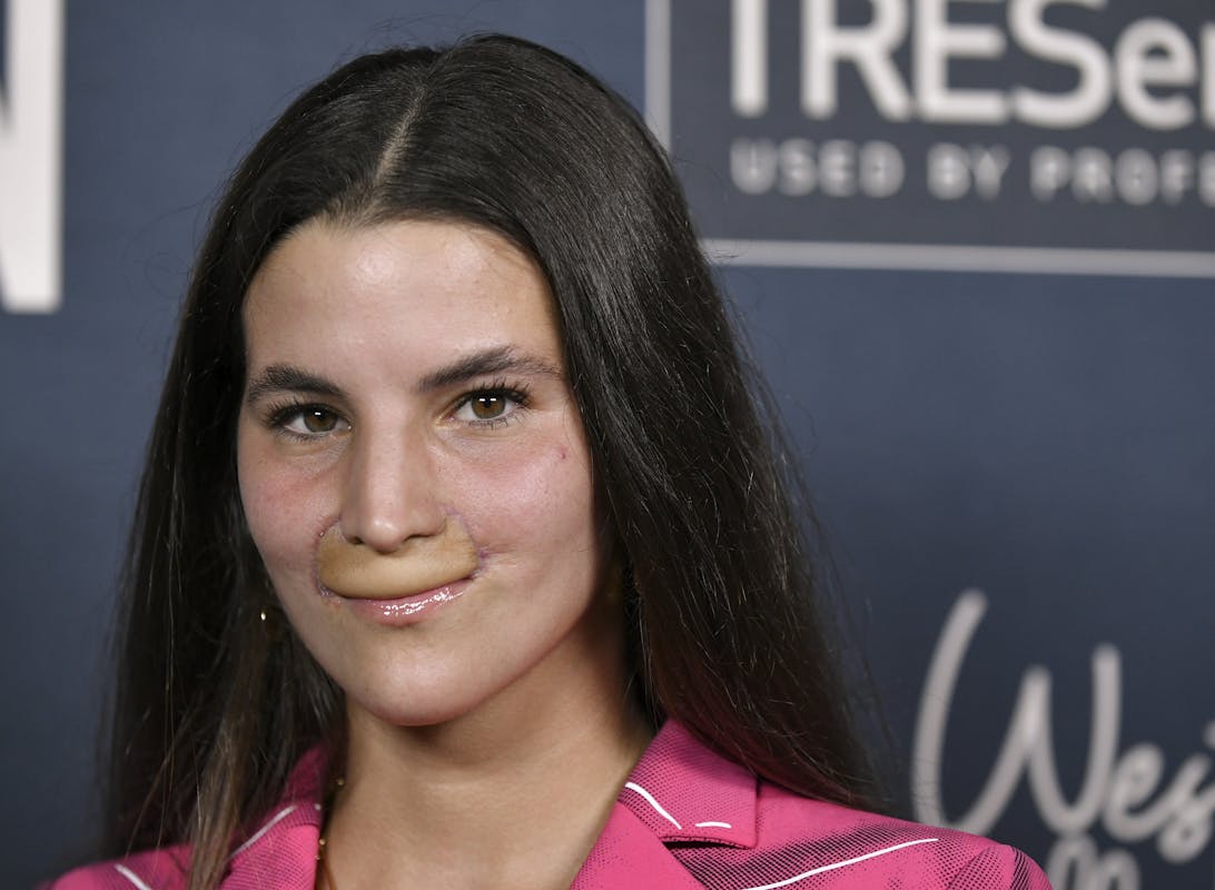 Pro Skateboarder And Model Shows Off New Face After Getting Mauled By A