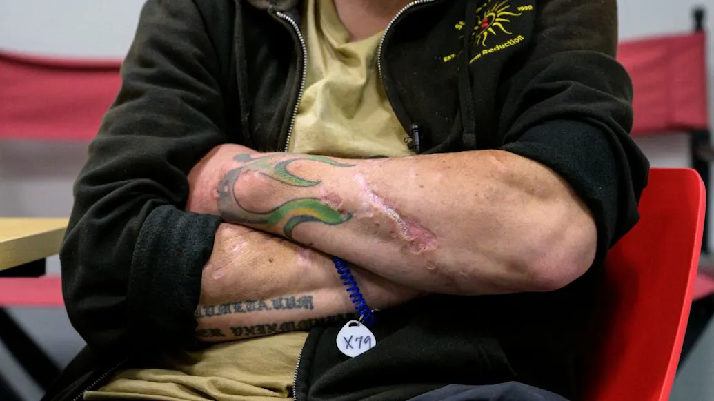 New York Doctors Scrambling As Flesh-Rotting ‘Zombie Drug’ Tranq Takes Over Streets