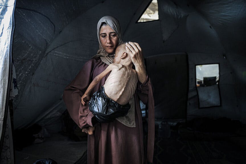GAZA CITY, GAZA - JULY 21: Muhammad Zakariya Ayyoub al-Matouq, a 1.5-year-old child in Gaza City, Gaza, faces life-threatening malnutrition as the humanitarian situation worsens due to ongoing Israeli attacks and blockade, on July 21, 2025. Having dropped from 9 to 6 kilograms, he struggles to survive in a tent in Gaza City, where milk, food, and other basic necessities are lacking. Suzan Marouf, a clinical nutrition specialist at Patient Friend’s Hospital, confirmed that Mohammad’s condition worsened due to severe malnutrition caused by the ongoing Israeli siege. When his family brought him to the hospital a month ago, doctors diagnosed him with moderate malnutrition in addition to pre-existing congenital health issues, including brain complications and muscle atrophy. Marouf said they had been trying to stabilize Mohammad’s condition using the last remaining nutritional supplements. "The medical issues he had weren’t significantly affecting his weight," she noted. (Photo by Ahmed Jihad Ibrahim Al-arini/Anadolu via Getty Images)