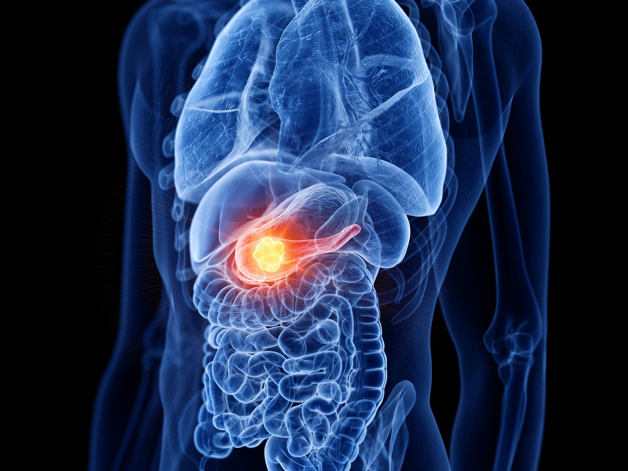 ‘Triple-Threat’ Breakthrough: New Therapy Eradicates Pancreatic Tumors In Preclinical Study
