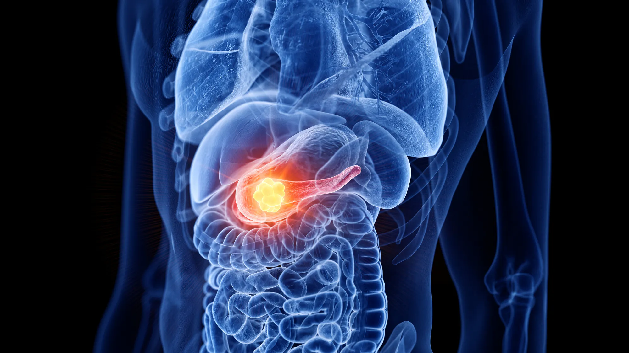 ‘Triple-Threat’ Breakthrough: New Therapy Eradicates Pancreatic Tumors In Preclinical Study
