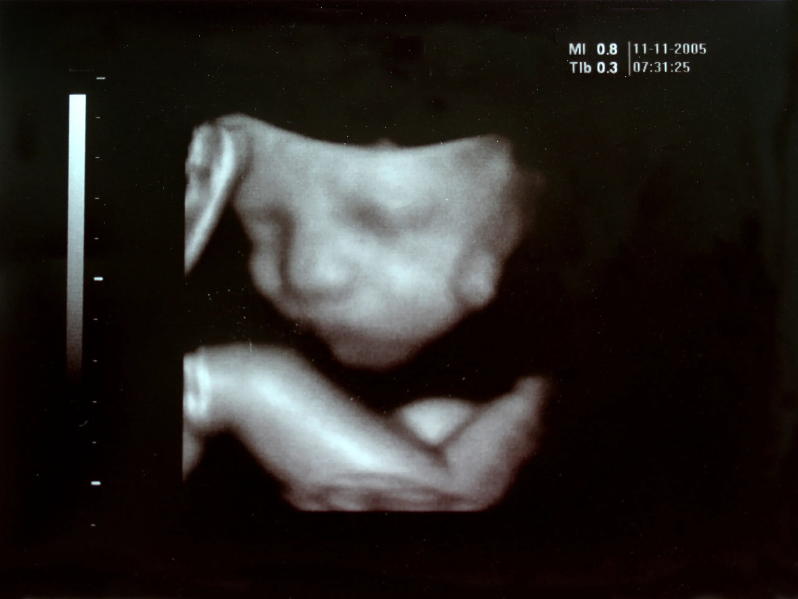 They Didn’t Get The Perfect Baby So At 5 Months They Murdered It