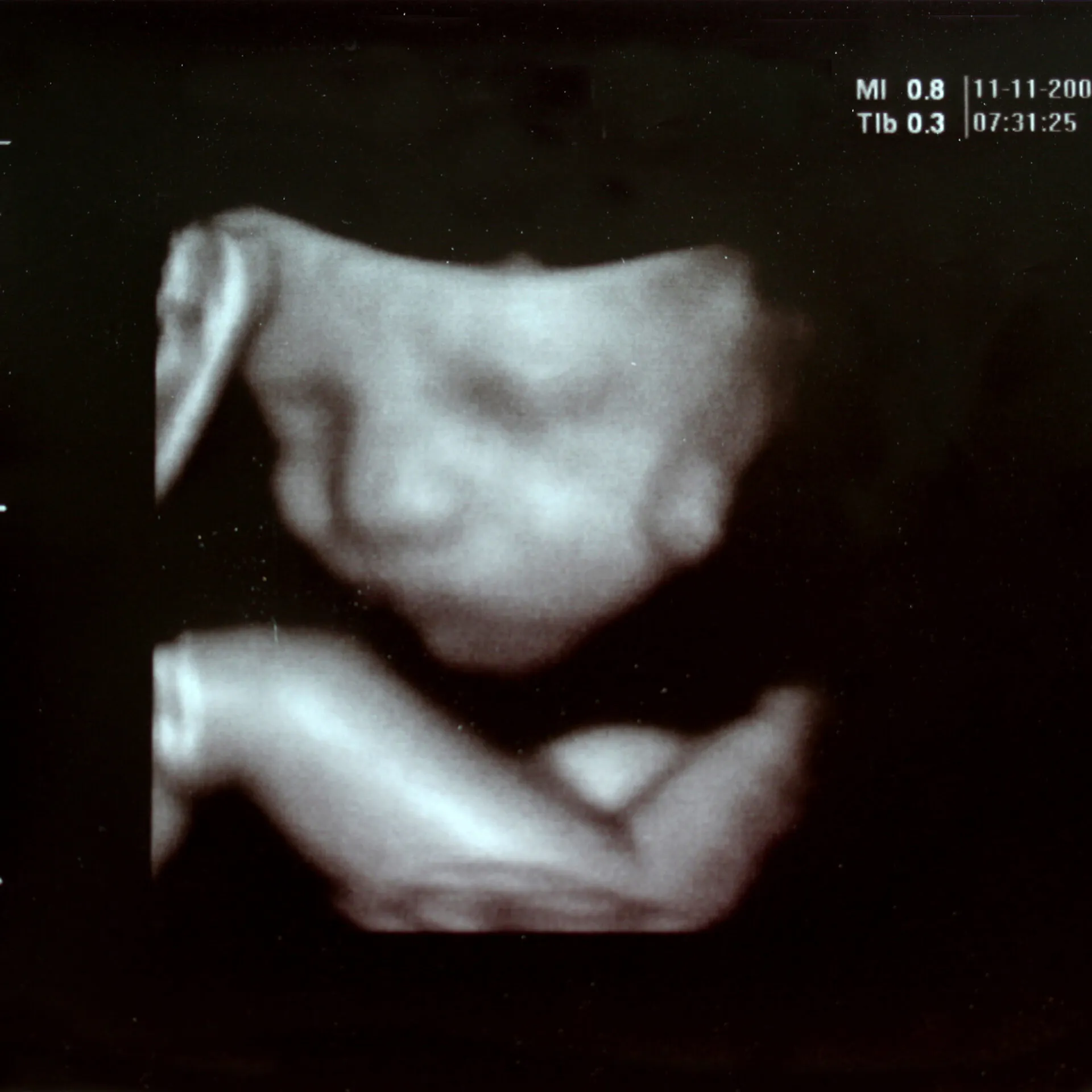 They Didn’t Get The Perfect Baby So At 5 Months They Murdered It
