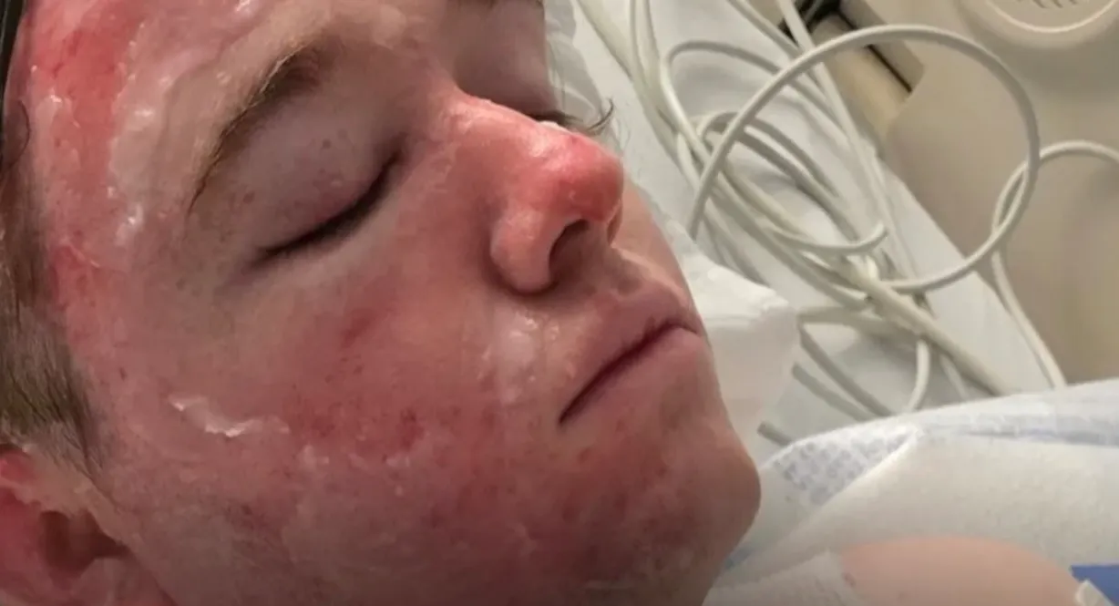 McDonald’s Worker Says He’s Fighting Severe Burns After Hot-Oil Attack