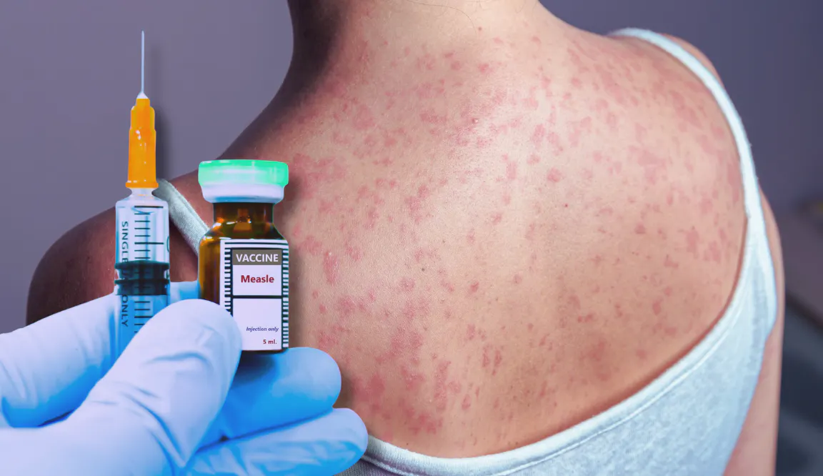 A Disease Once Thought Defeated Is Spreading Across America