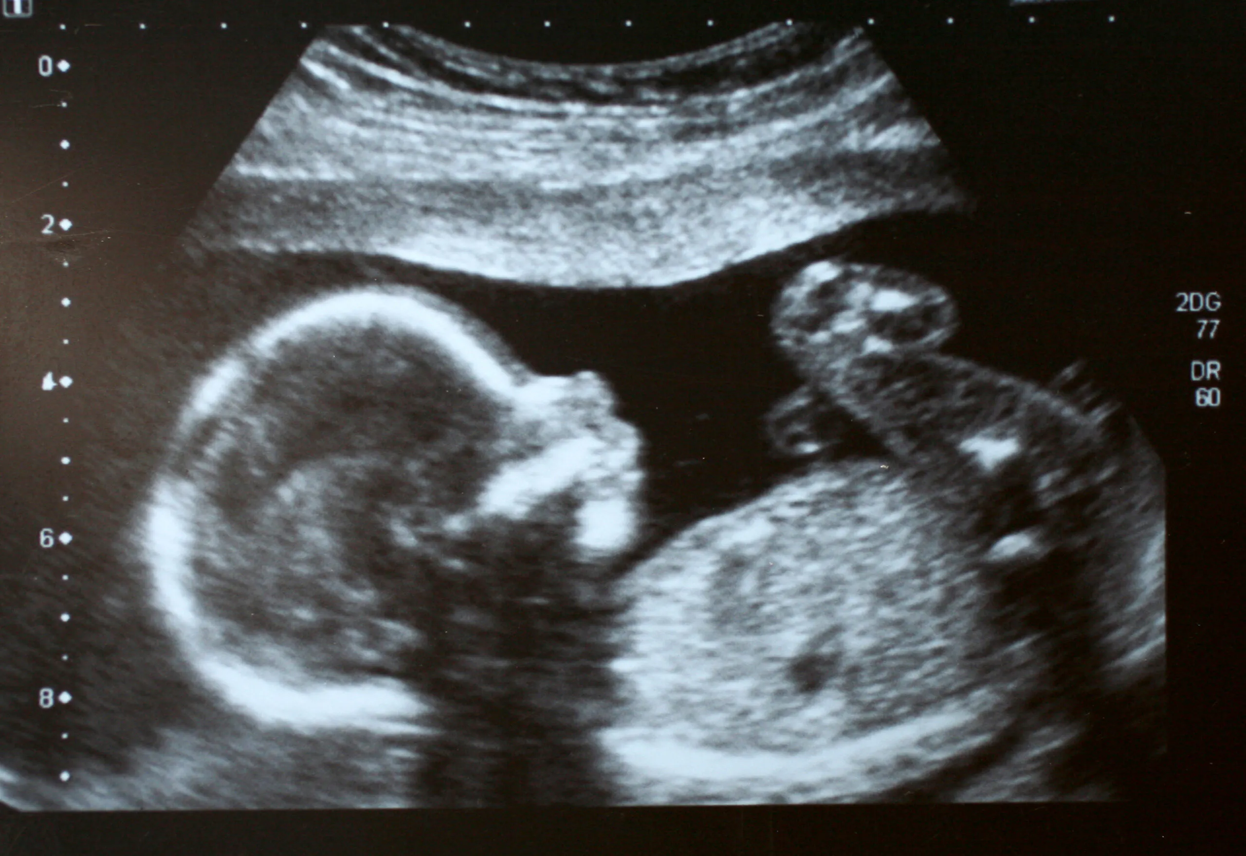 Federal Pro-Life Protection Hits Major Milestone As New Attacks Emerge